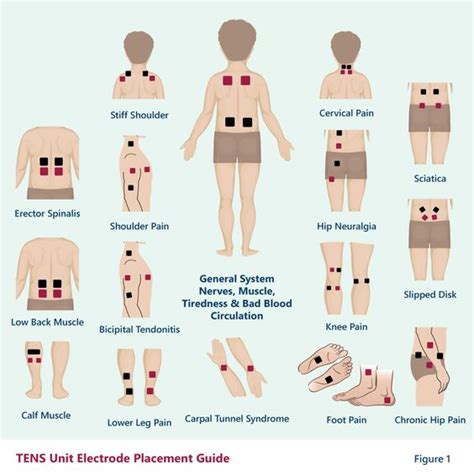 Electrode Placement For Electrical Stimulation Chart