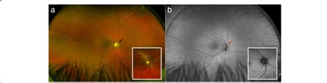 Ultra Widefield Retinal Imaging Of The Right Retina A Ultra Widefield
