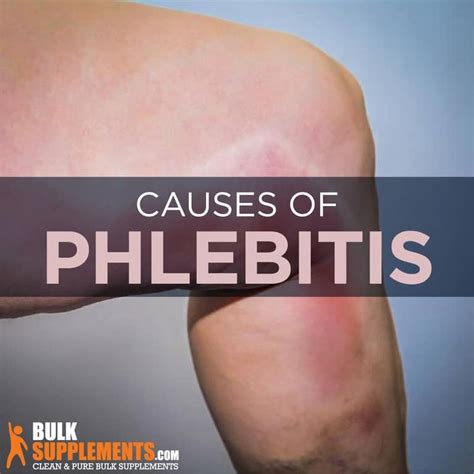 Phlebitis Symptoms Causes And Treatment