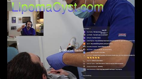 Massive Cyst Removal Dr Khaled Sadek Live Chat 5th Feb 2023 Youtube