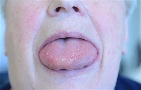 Female Patient With Acute Swelling Of The Tongue Due To Treatment With