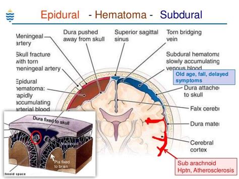 Difference Between Epidural Subdural And Subarachnoid Hemorrhage