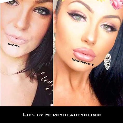 Image Result For Keyhole Lip Injections Before And After Pictures