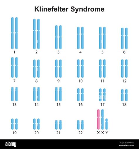 Cariotipo Del Sindrome De Klinefelter Imágenes Recortadas De Stock