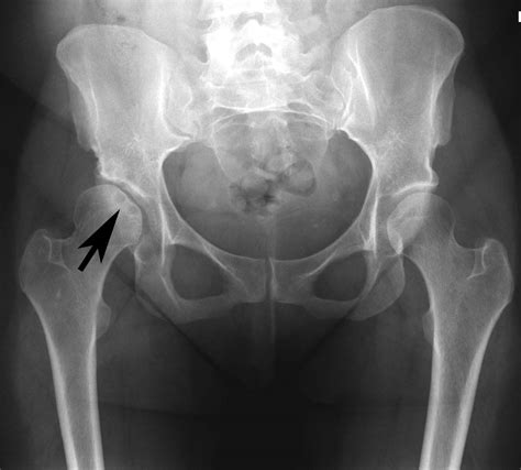 A Case Of Femoral Head Avascular Necrosis