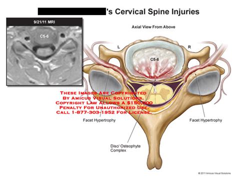 Amicus Illustration Of Amicus Injury Cervical Spine Injuries Mri C5 6