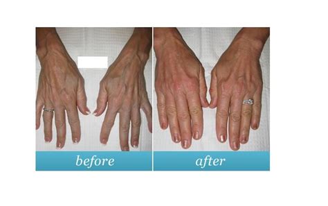 Hand Veins Sclerotherapy Yelp