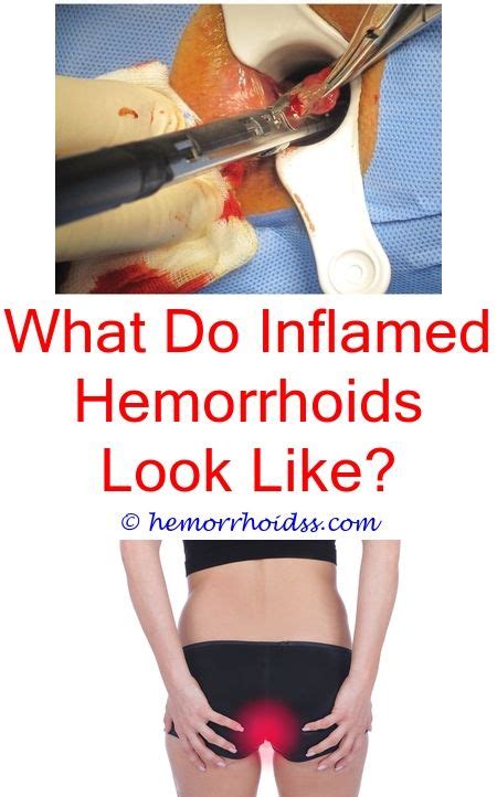Pin On Hemorrhoids Cure
