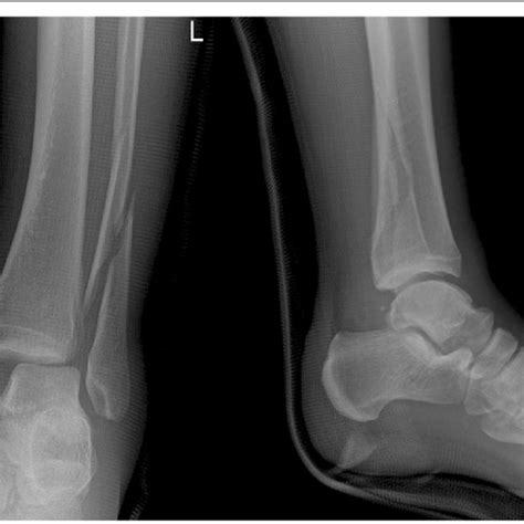 Anteroposterior And Lateral Plain Ankle Radiographs Of The Initial