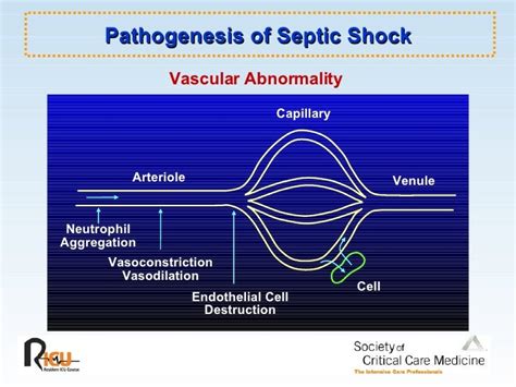 What Is Septic Shock Systemic Inflammatory Response Syndrome Sirs
