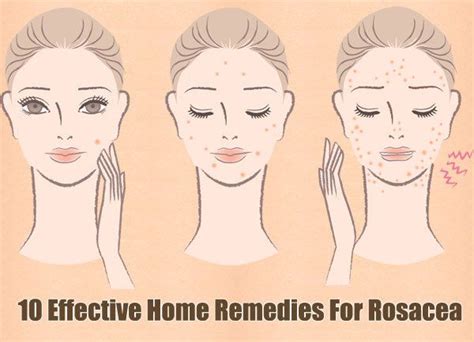 10 Effective Home Remedies For Rosacea Home Remedies For Rosacea