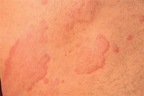 Solar Urticaria How You Can Get Hives From The Sun The Healthy