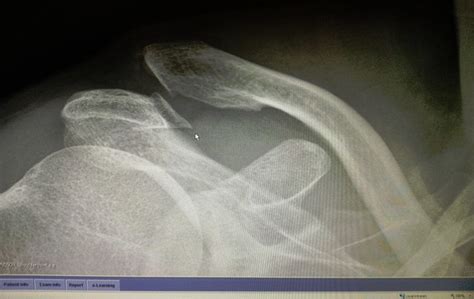 Dislocated Clavicle Do Not Fall Off A Bike On A Roundabout Flickr