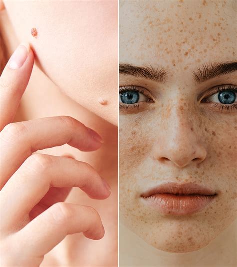 Freckle Vs Mole Whats The Difference And Is It Dangerous