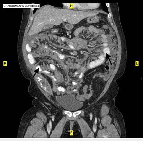 Ct Abdomen With Contrast Showing Peritoneal Nodularity Stranding And