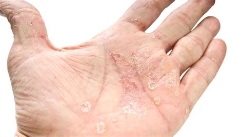 Link Between Psoriasis And Diabetes Yourcareeverywhere