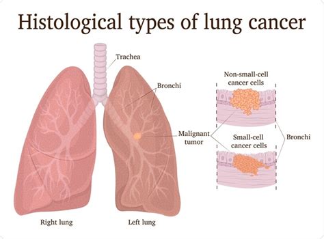 What Are The Differences Between Small Cell And Non Small Cell Lung