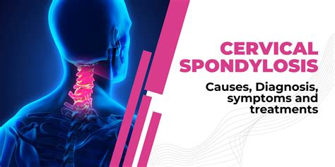 How To Cure Cervical Spondylosis Causes Symptoms And