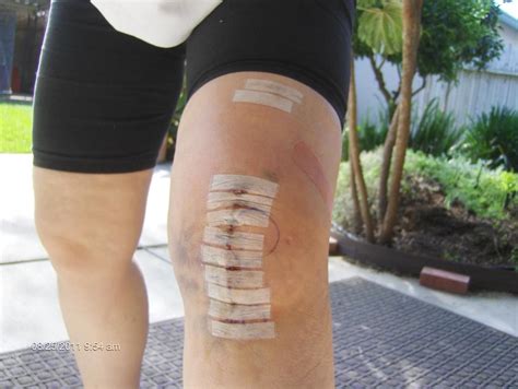 This can help to improve circulation and minimize the risk of scarring and contracture of the tissues around the knee. Here is my right knee one day after Makoplasty. 5 weeks ...