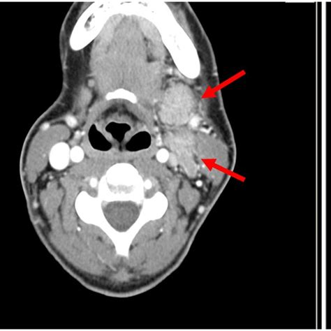 Ct Scan Of The Head With Submandibulary Gland Tumor Multiple Nodes And
