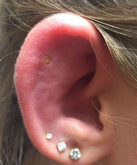 Ear Piercing Infection Causes Symptoms Pictures Bump And Treatment Of Old Piercing American
