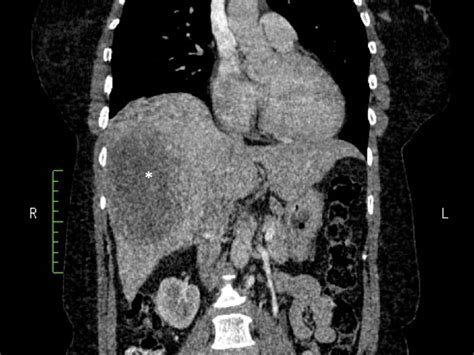 Coronal Views Of A Contrast Enhanced Ct Scan Of The Liver Revealing A
