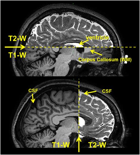 T And T Mri Signals