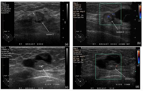 Unusual Mammographic And Ultrasound Findings In A Patient With Ductal