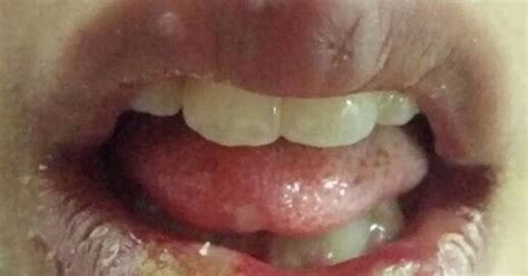 My Day In Clinic The Case Of Herpetic Gingivostomatitis