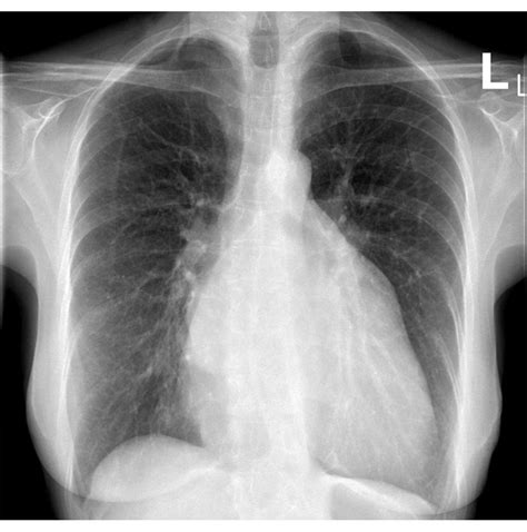 Systemic Lupus Erythematosus X Ray Wikidoc
