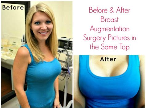 8 Weeks Post Op Breast Augmentation Surgery