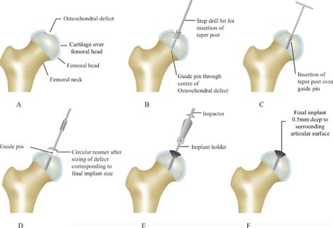 Hemicap Hip Partial Resurfacing Technique A Osteochondral Defect In