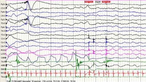 E Ictal Eeg Of A Child With Benign Sleep Myoclonus In The Modified