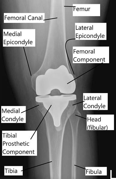 Total Knee Replacement Knee Specialist In Ny Complete Orthopedics