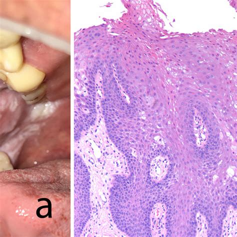 A Leukoedema Of The Left Buccal Mucosa In A 58 Year Old Black Female