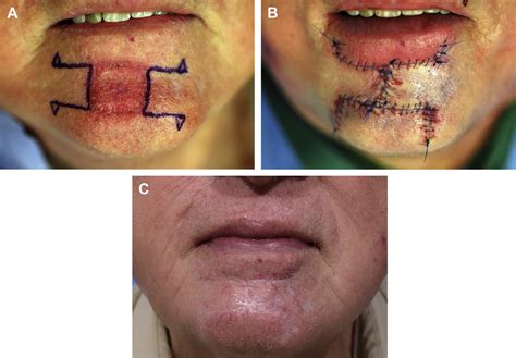 Reconstruction Of Mohs Defects Of The Lips And Chin Facial Plastic Surgery Clinics