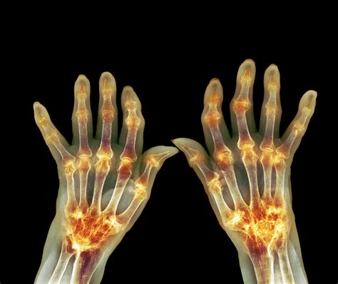 Case Study Cardiac Manifestations Of Rheumatoid Arthritis