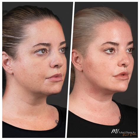 Cheek Enhancement With Dermal Fillers M1 Med Beauty Australia