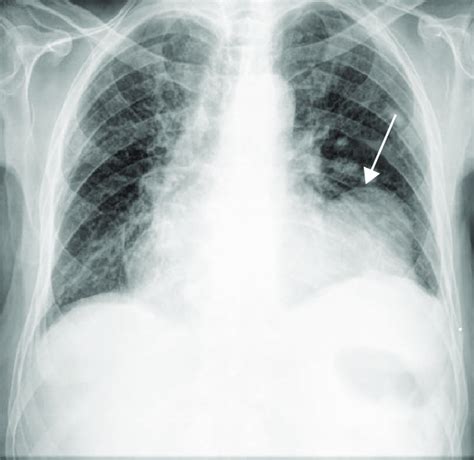 Chest X Ray Showing Cardiomegaly And A Radioopaque Mass Next To The