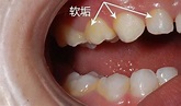 牙齒上經常附著黃色的牙垢，該怎麼辦？ - 壹讀