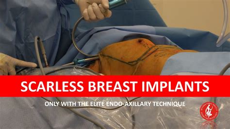 Endo Axillary Breast Augmentation For Breast Implants With No Scars And Beautiful Cleavage Youtube