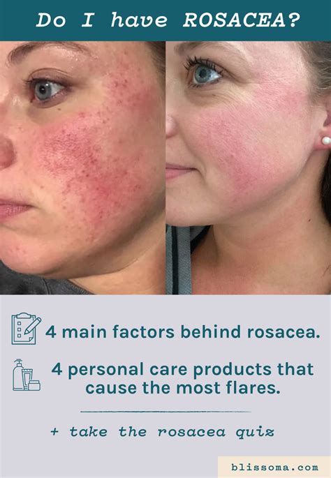 Do I Have Rosacea Your Microbiome May Be Partly To Blame For Red