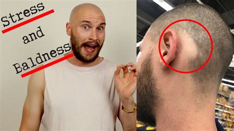 15 Difference Between Stress Hair Loss And Male Pattern Baldness