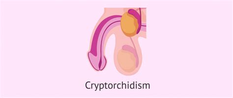 What Is Cryptorchidism