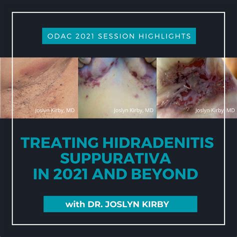 Treatment Of Hidradenitis Suppurativa In 2021 And Beyond Next Steps In