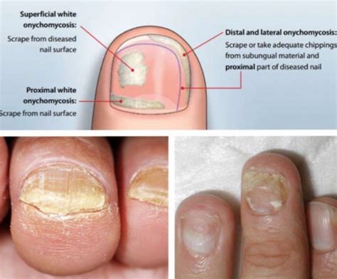 Toe Nails Fungus Is Very Common Many People Get It In Various Ways