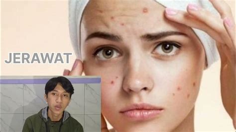 Penjelasan Singkat Tentang Penyakit Jerawat Tugas Patofisiologi Youtube