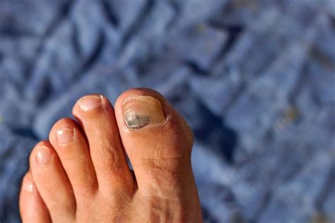 The Nine Types Of Toenails You Will Find In The Running Scene