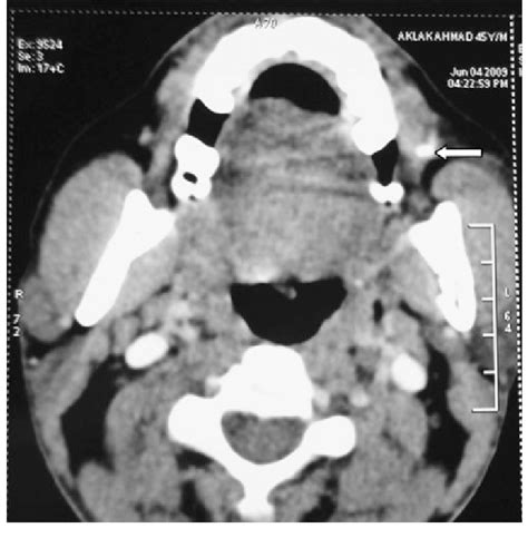 Ct Scan Axial Cut Showing Hyperdense Shadow Calculus In The