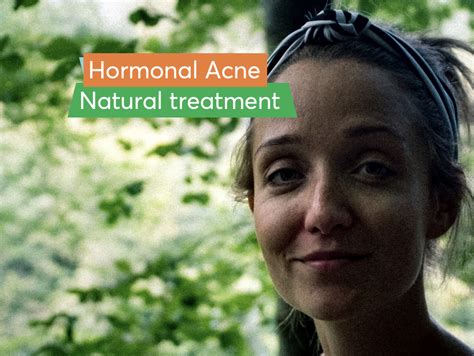 How Can I Treat Hormonal Acne Naturally Mdacne